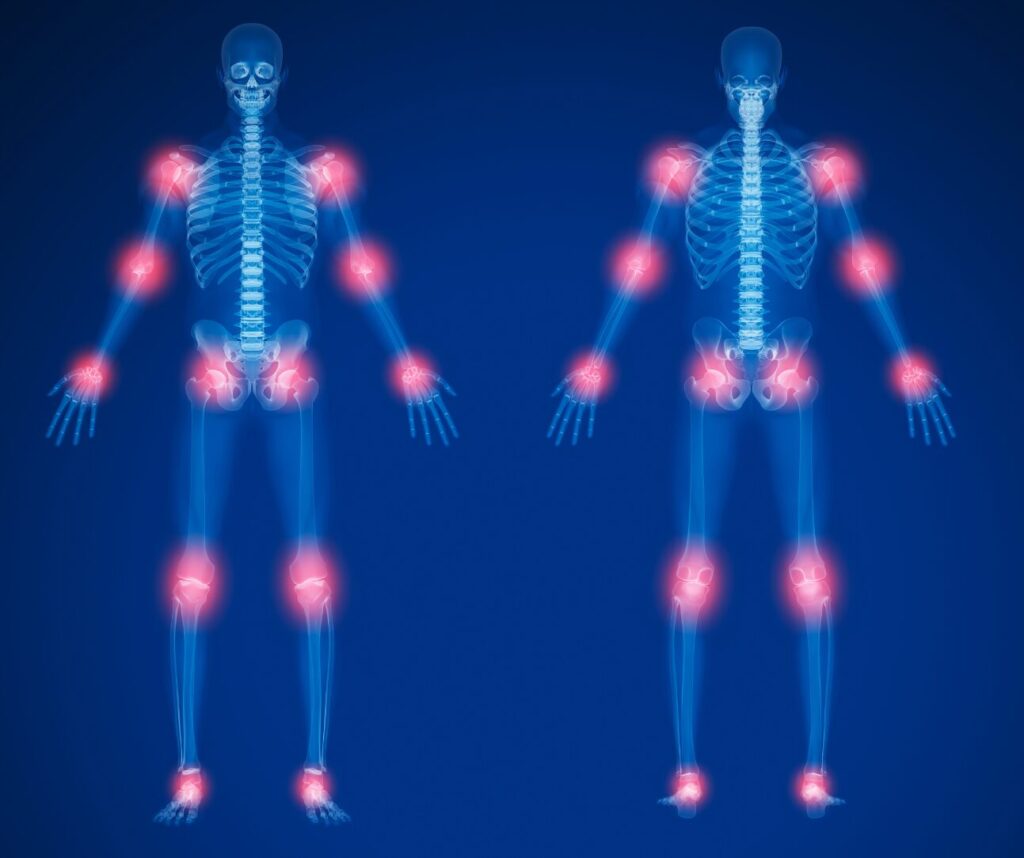 THS 1SpBl Osteoarthritis (61025)